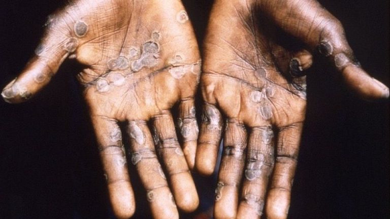 Monkeypox නවතම තත්වය