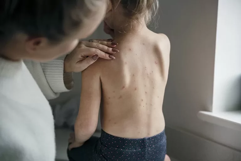එක්සත් රාජධානියේ සියලුම දරුවන්ට Chickenpox එන්නත් ලබාදීමට උපදෙස්!
