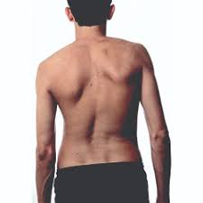 ශ්‍රී ලංකාවෙන් පැතිකුදය (Scoliosis) රෝග තත්ත්වය තුරන් කිරීමේ මෙහෙයුමට පා ගමනක්!