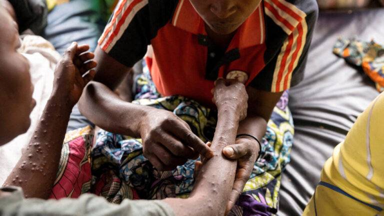Mpox රෝගීන් සිම්බාබ්වෙනුත්!