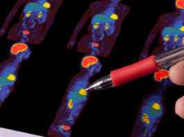 පිළිකා මර්දන සටනේ ශ්රී ලංකාව ලැබූ දැවැන්ත ජයග්රහණයක්!