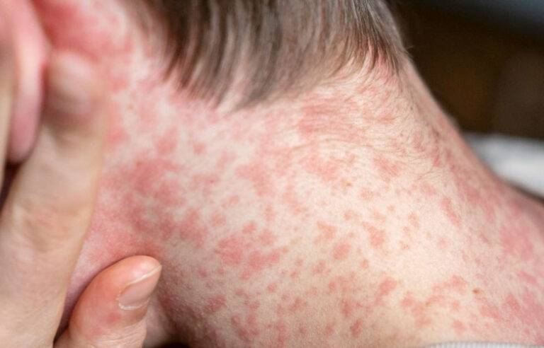 බංග්ලාදේශයේ සරම්ප රෝගය නැවත හිස ඔසවයි; මාසයක් තුළ මියගිය සංඛ්‍යාව 100 ඉක්මවයි